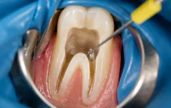 Close-up view of a tooth during pediatric root canal treatment to remove infected dental pulp.