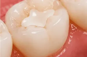 Natural-looking tooth-colored filling repairing a cavity while blending with the surrounding tooth.