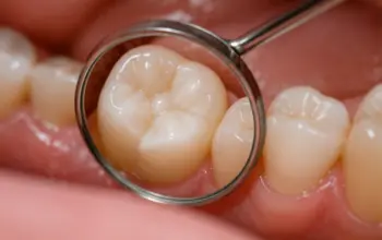 Pediatric dentist examining a child's tooth before or during a tooth-colored filling procedure.